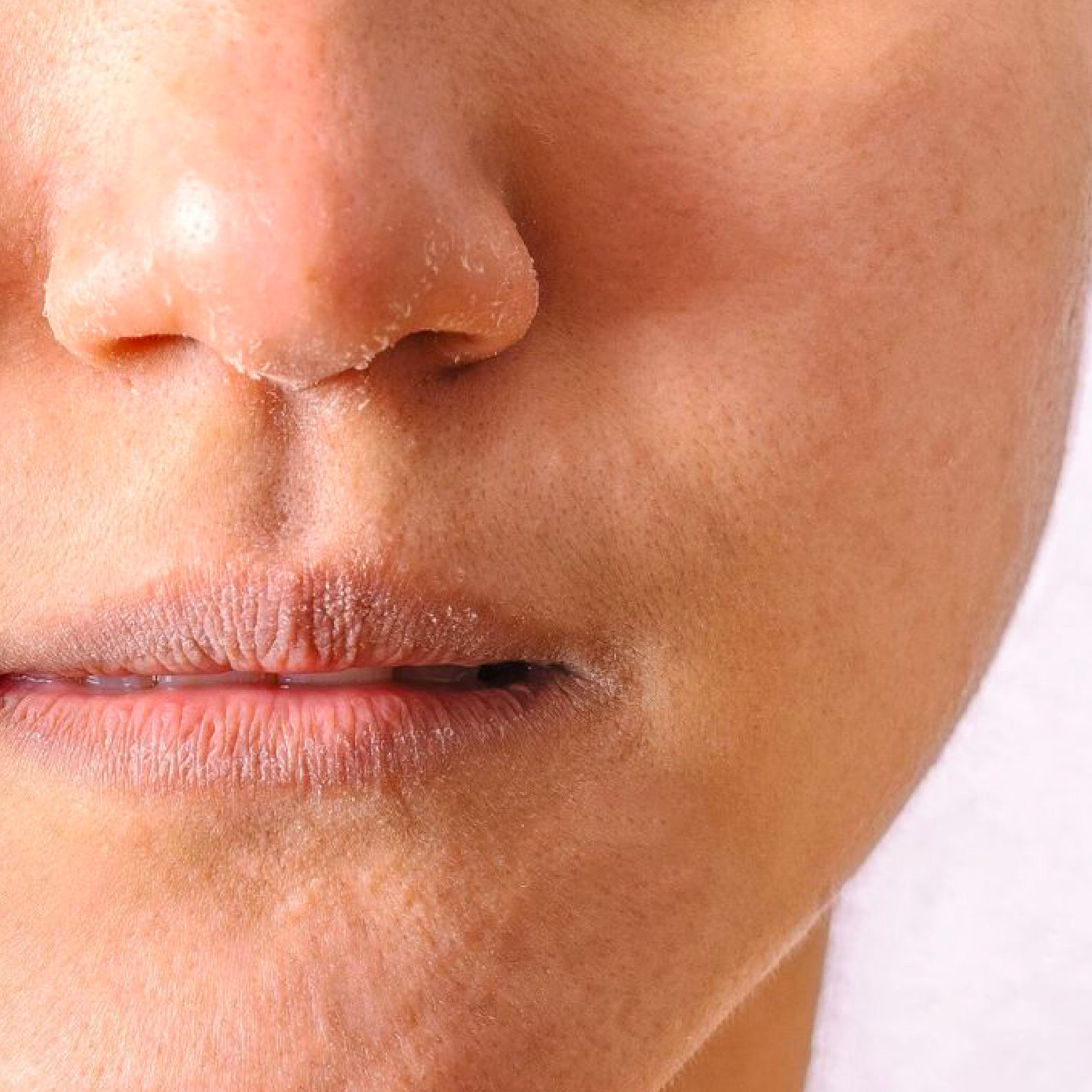 Dryness & Dehydration